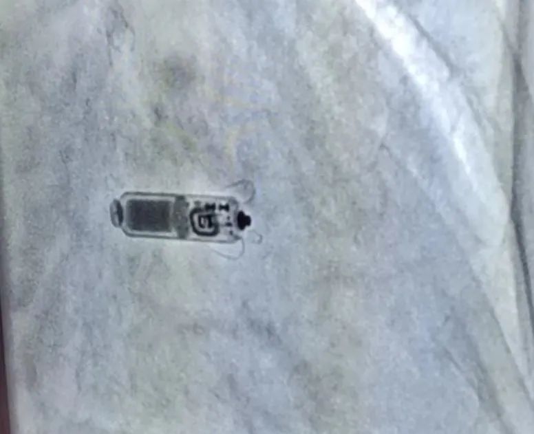 全國(guó)首批！遼西首例！葫蘆島市第二人民醫(yī)院心臟中心完成遼西首例Micra AV無導(dǎo)線起搏器植入術(shù)(圖4)